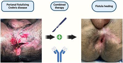 Nutritional status in perianal Crohn’s disease: are we underestimating the impact?